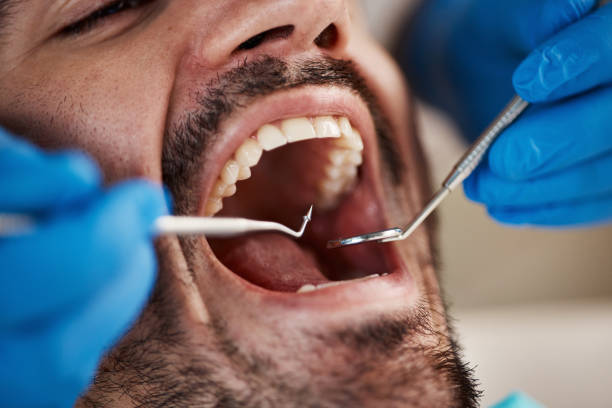 Best Emergency Wisdom Teeth Removal in Lisle, IL