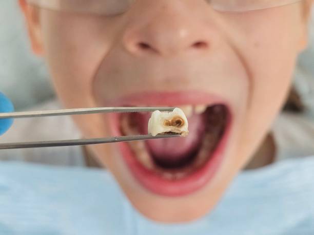 Best Emergency Root Canal Treatment in Lisle, IL